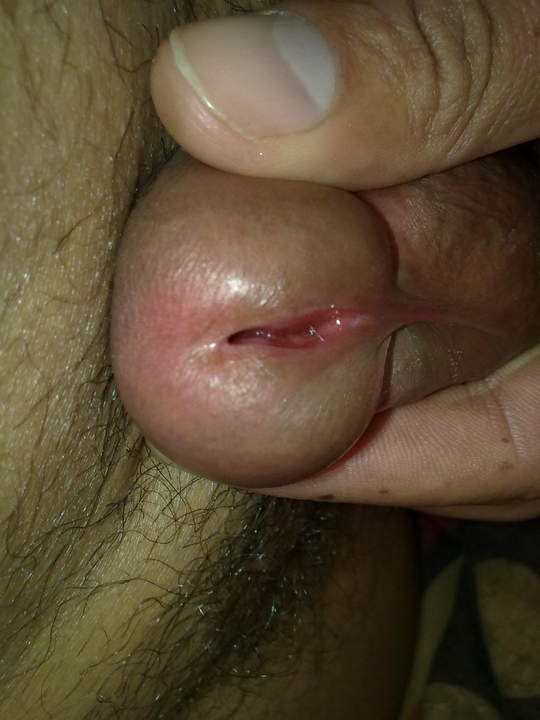 Photo of a penile from Jeffy