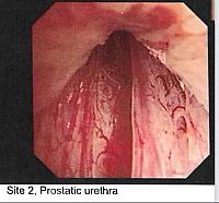 Endoscopy Internal Cock Pic 1